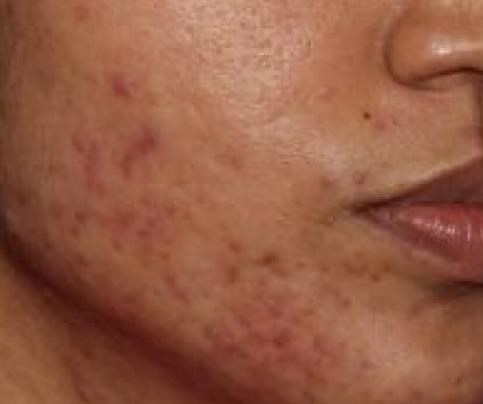 Acne Before (3)