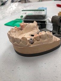 Hybrid Custom Abutment