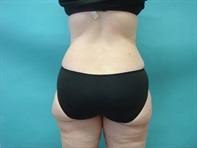 Dr. Serra Plastic Surgery Before & After